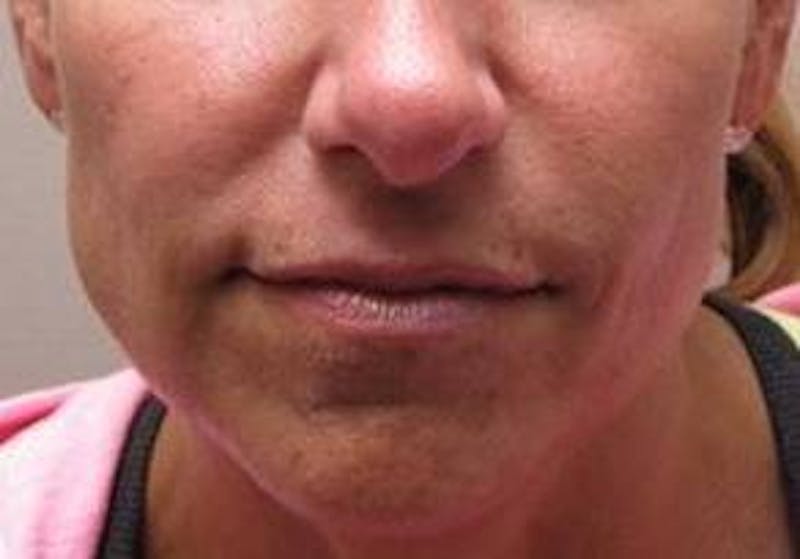 Dermal Fillers Before & After Gallery - Patient 721572 - Image 2 - Scott Chapin, MD