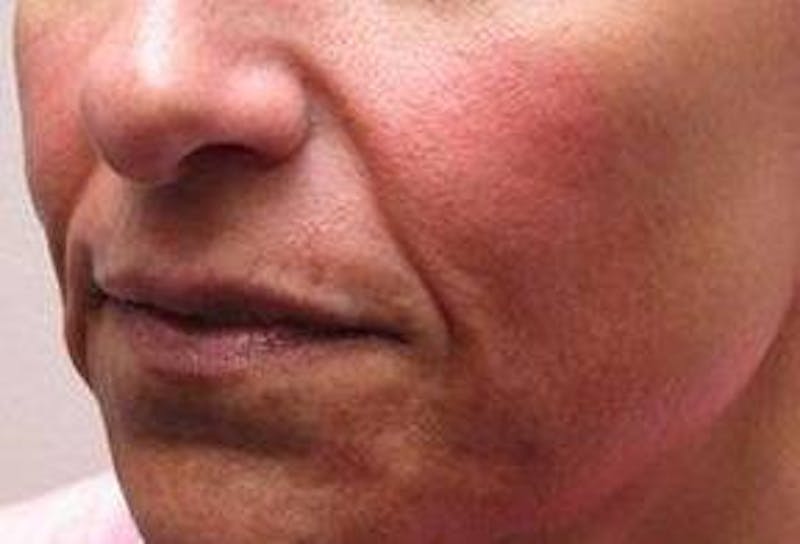 Dermal Fillers Before & After Gallery - Patient 721572 - Image 3 - Scott Chapin, MD