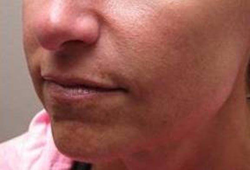 Dermal Fillers Before & After Gallery - Patient 721572 - Image 4 - Scott Chapin, MD