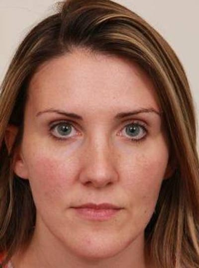Dermal Fillers Before & After Gallery - Patient 167851 - Image 2 - Scott Chapin, MD