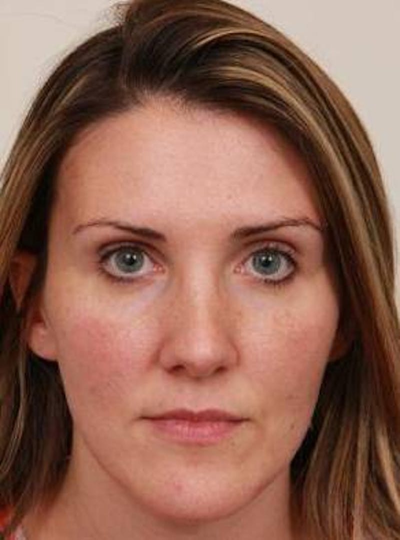 Dermal Fillers Before & After Gallery - Patient 167851 - Image 2 - Scott Chapin, MD