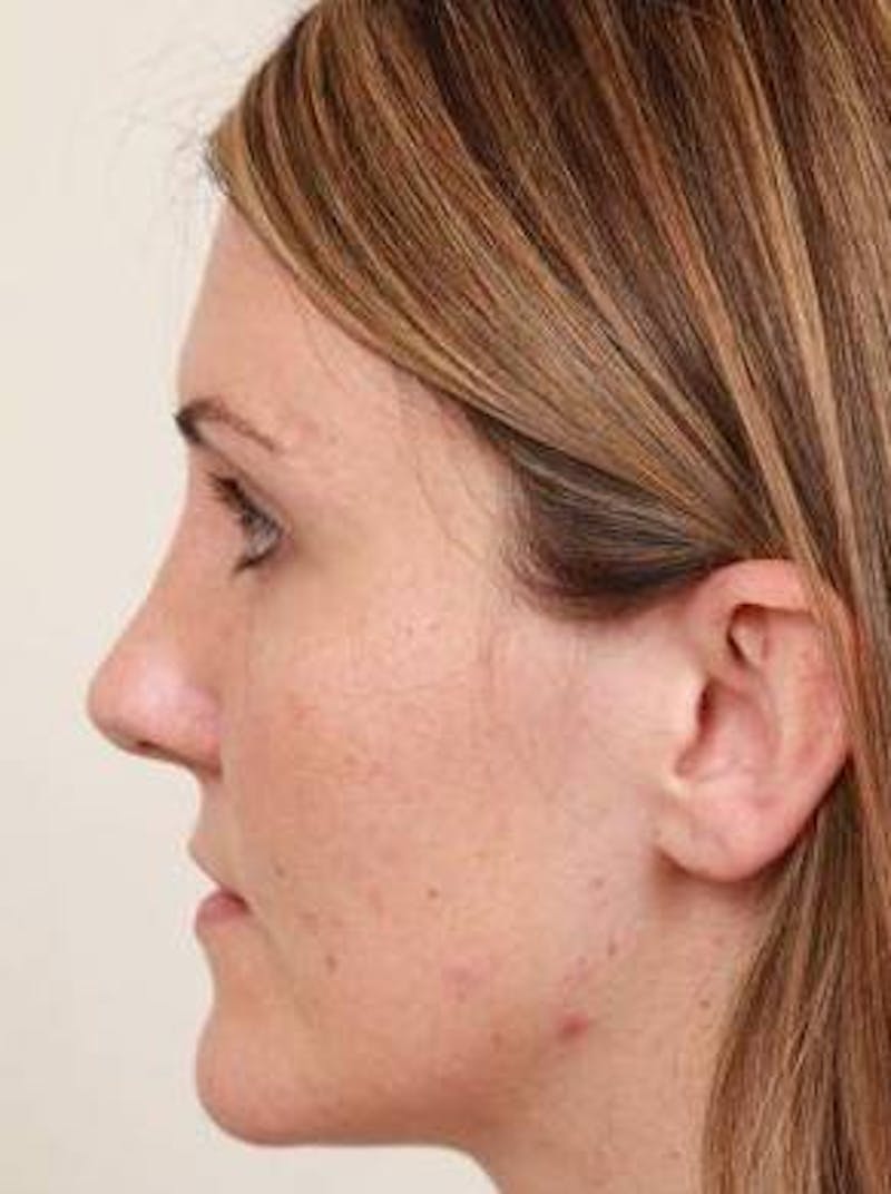 Dermal Fillers Before & After Gallery - Patient 167851 - Image 3 - Scott Chapin, MD