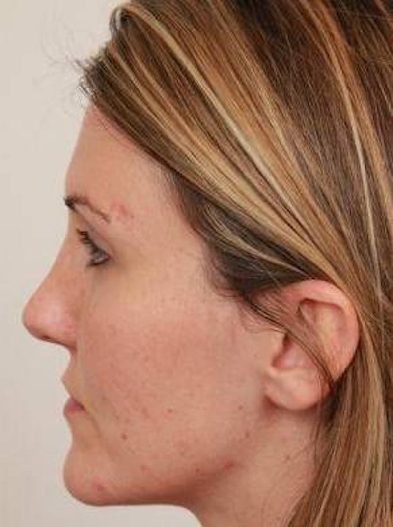 Dermal Fillers Before & After Gallery - Patient 167851 - Image 4 - Scott Chapin, MD