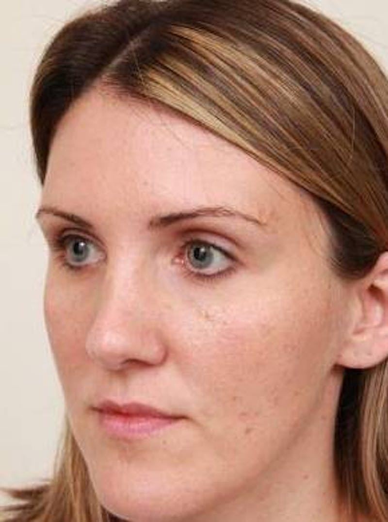 Dermal Fillers Before & After Gallery - Patient 167851 - Image 5 - Scott Chapin, MD