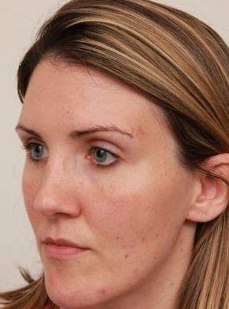 Dermal Fillers Before & After Gallery - Patient 167851 - Image 6 - Scott Chapin, MD