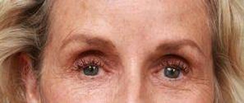 Dermal Fillers Before & After Gallery - Patient 413420 - Image 1 - Scott Chapin, MD