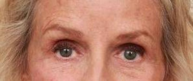 Dermal Fillers Before & After Gallery - Patient 413420 - Image 2 - Scott Chapin, MD