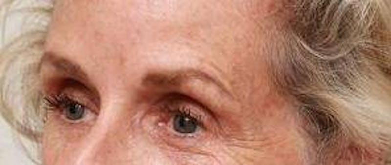 Dermal Fillers Before & After Gallery - Patient 413420 - Image 3 - Scott Chapin, MD