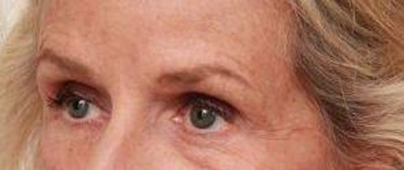 Dermal Fillers Before & After Gallery - Patient 413420 - Image 4 - Scott Chapin, MD