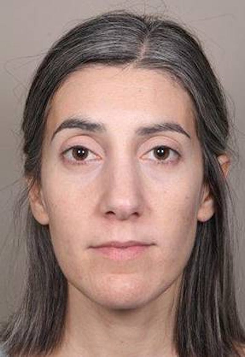 Voluma Before & After Gallery - Patient 202143 - Image 1 - Scott Chapin, MD