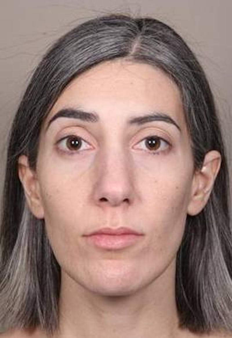Voluma Before & After Gallery - Patient 202143 - Image 2 - Scott Chapin, MD