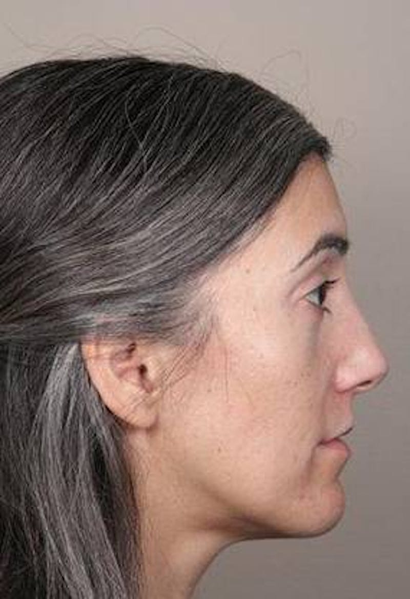 Voluma Before & After Gallery - Patient 202143 - Image 3 - Scott Chapin, MD