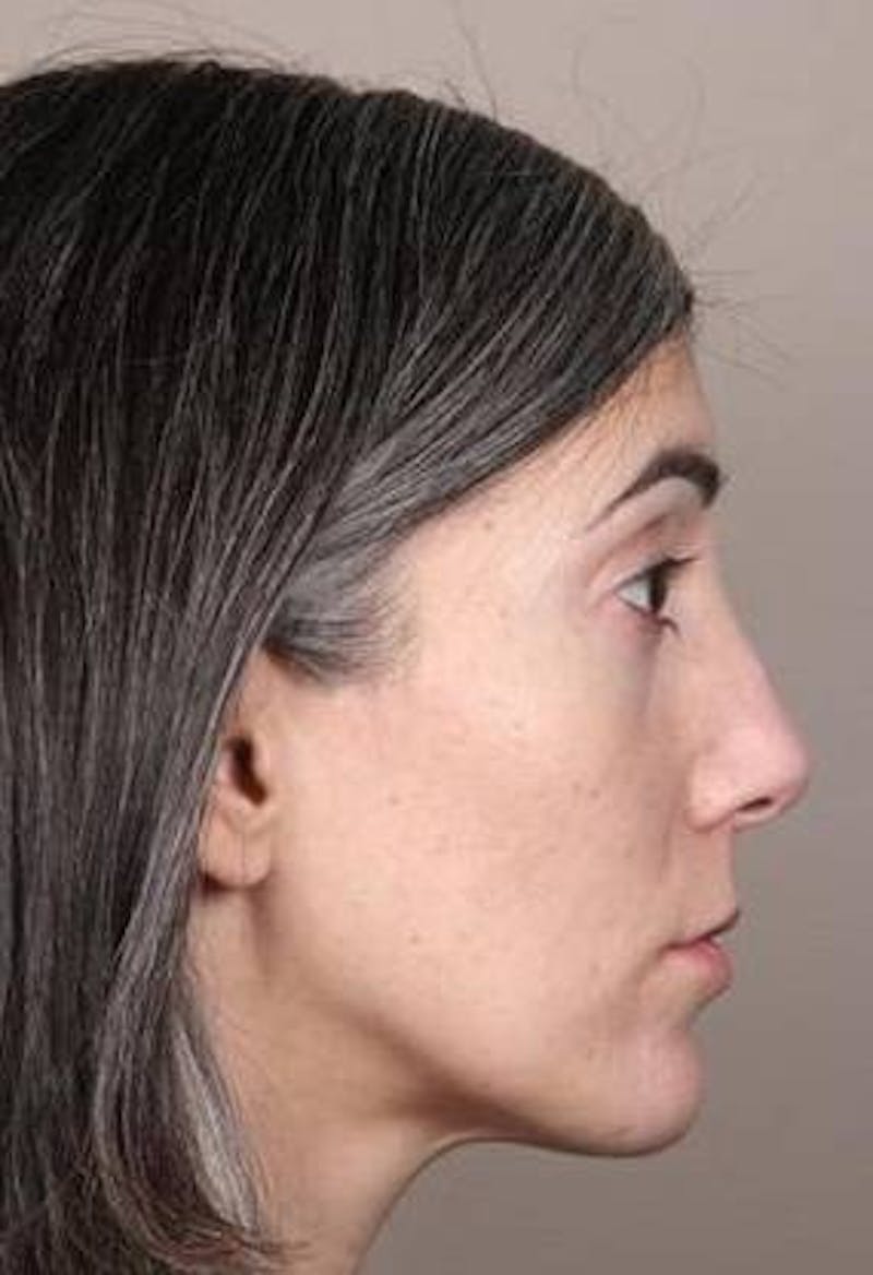 Voluma Before & After Gallery - Patient 202143 - Image 4 - Scott Chapin, MD