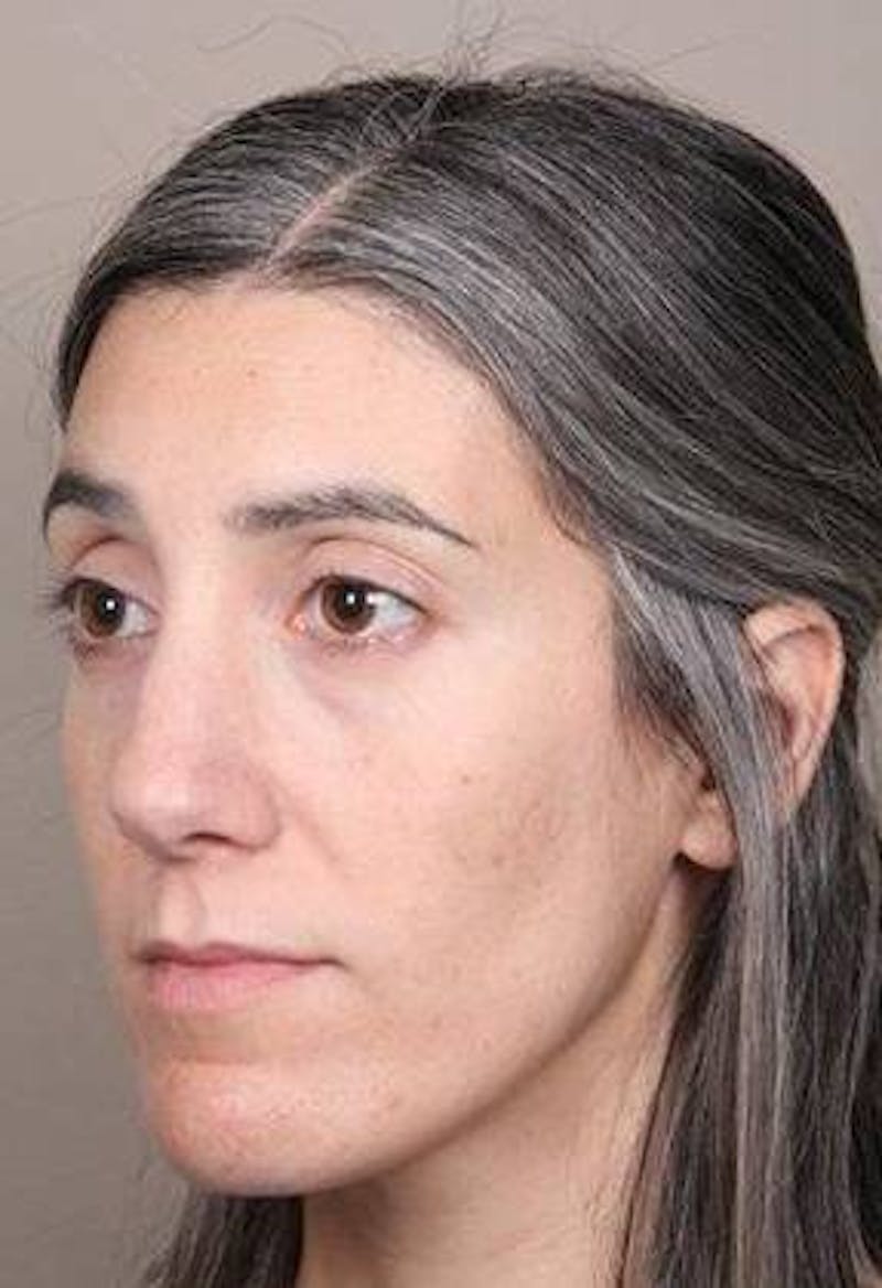 Voluma Before & After Gallery - Patient 202143 - Image 5 - Scott Chapin, MD