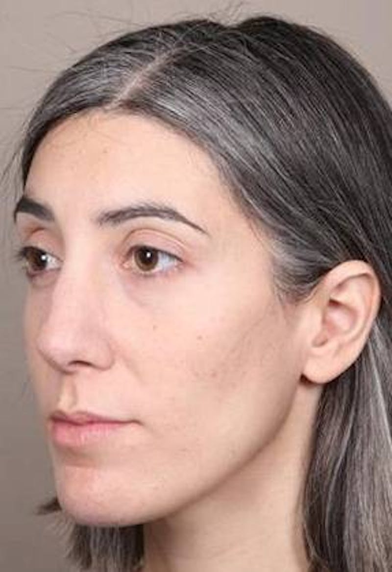 Voluma Before & After Gallery - Patient 202143 - Image 6 - Scott Chapin, MD