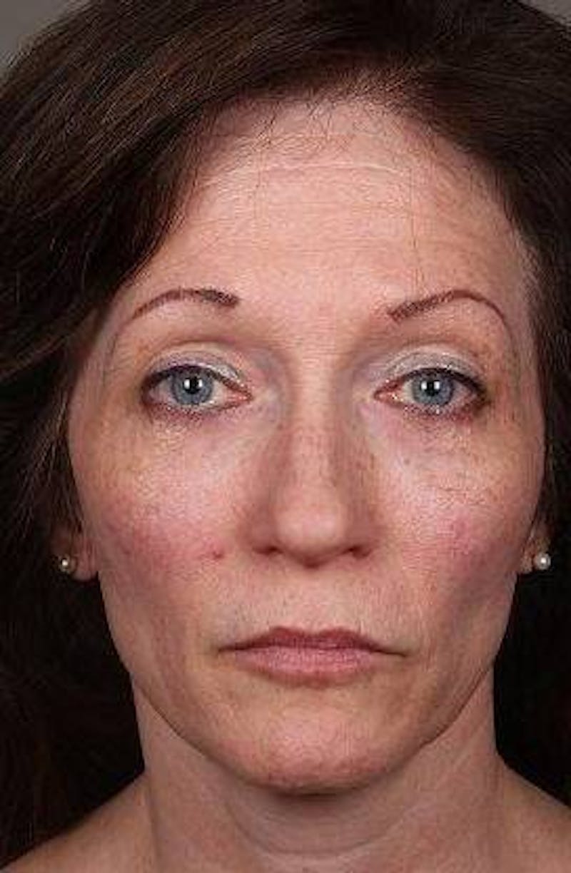 Voluma Before & After Gallery - Patient 813024 - Image 1 - Scott Chapin, MD