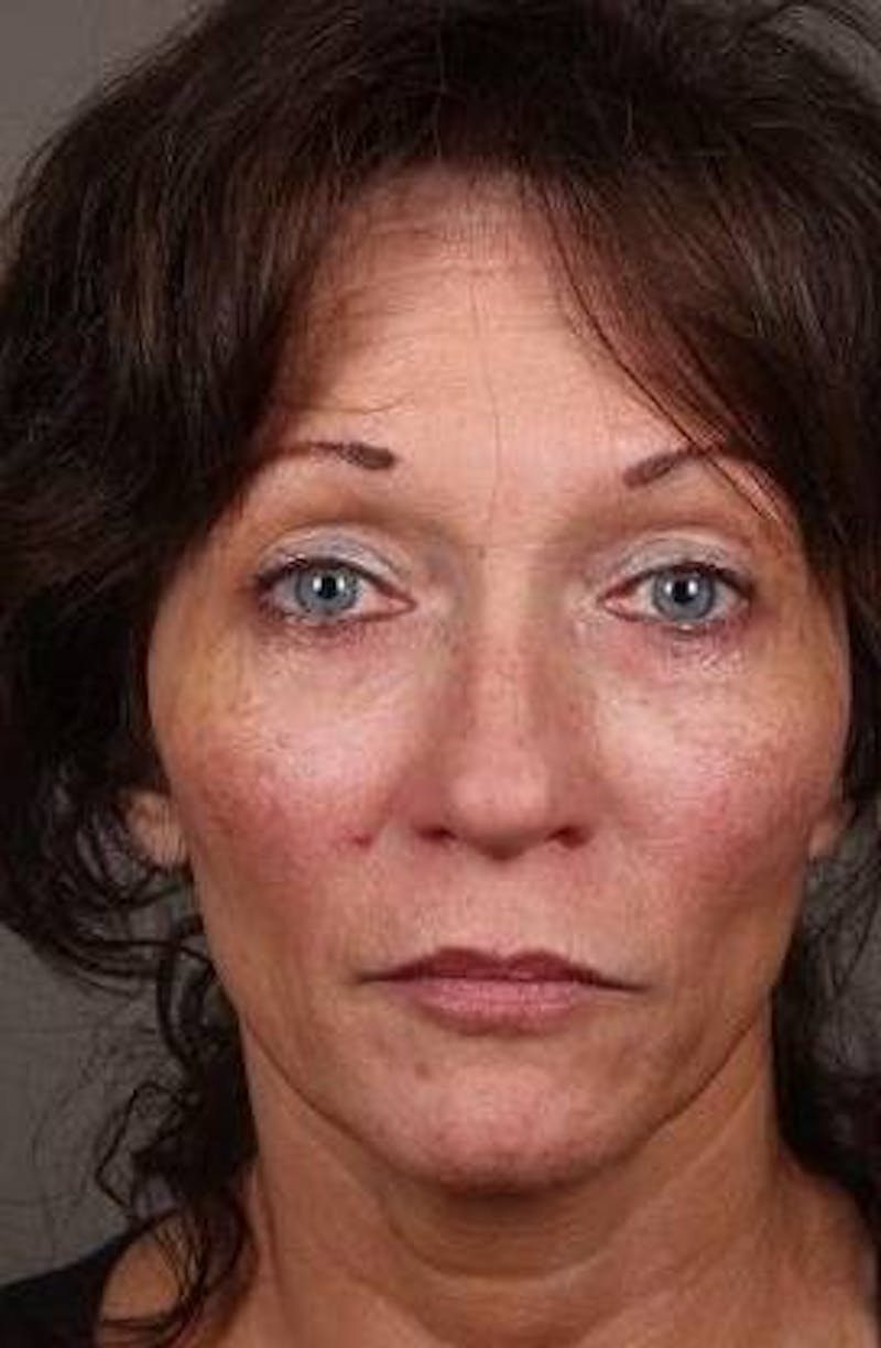 Voluma Before & After Gallery - Patient 813024 - Image 2 - Scott Chapin, MD