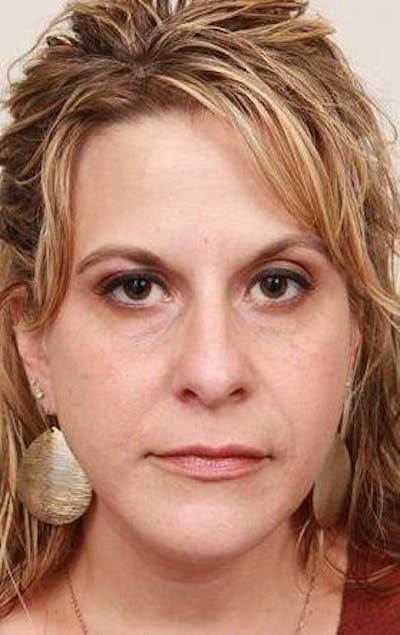 Voluma Before & After Gallery - Patient 385383 - Image 2 - Scott Chapin, MD