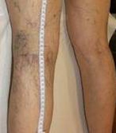 Spider Vein Removal | Varicose Vein Removal Before & After Gallery - Patient 270174 - Image 1 - Scott Chapin, MD