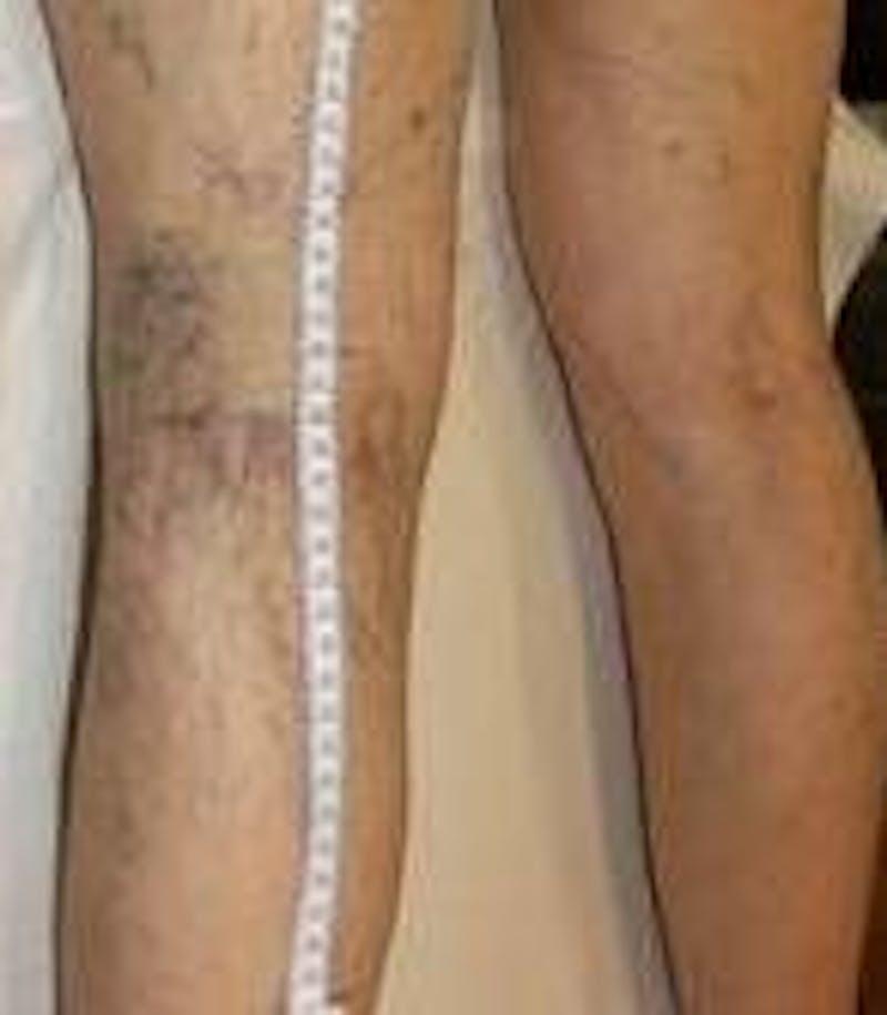 Spider Vein Removal | Varicose Vein Removal Before & After Gallery - Patient 270174 - Image 1 - Scott Chapin, MD
