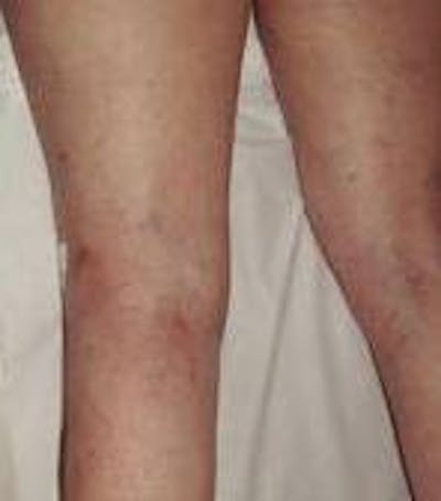 Spider Vein Removal | Varicose Vein Removal Before & After Gallery - Patient 270174 - Image 2 - Scott Chapin, MD