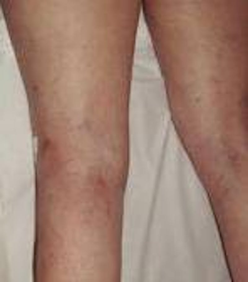 Spider Vein Removal | Varicose Vein Removal Before & After Gallery - Patient 270174 - Image 2 - Scott Chapin, MD