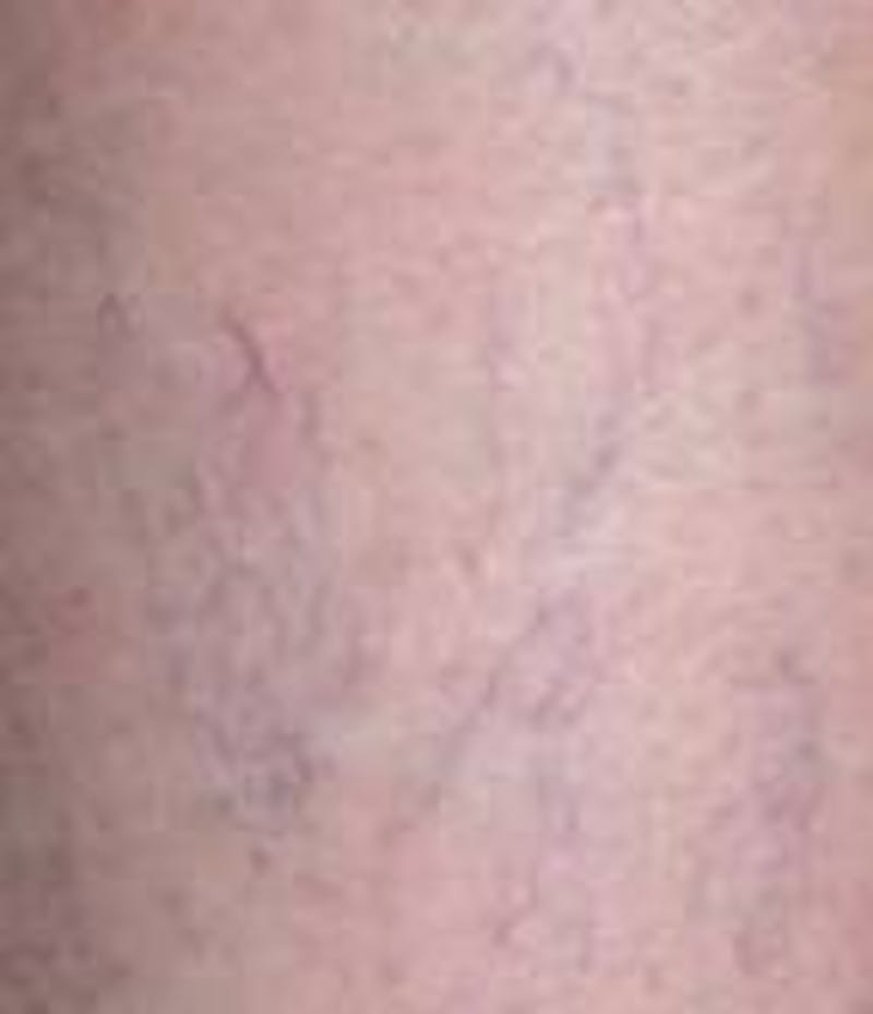 Spider Vein Removal | Varicose Vein Removal Before & After Gallery - Patient 270174 - Image 3 - Scott Chapin, MD