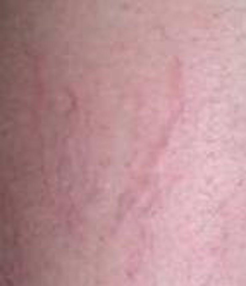 Spider Vein Removal | Varicose Vein Removal Before & After Gallery - Patient 270174 - Image 4 - Scott Chapin, MD