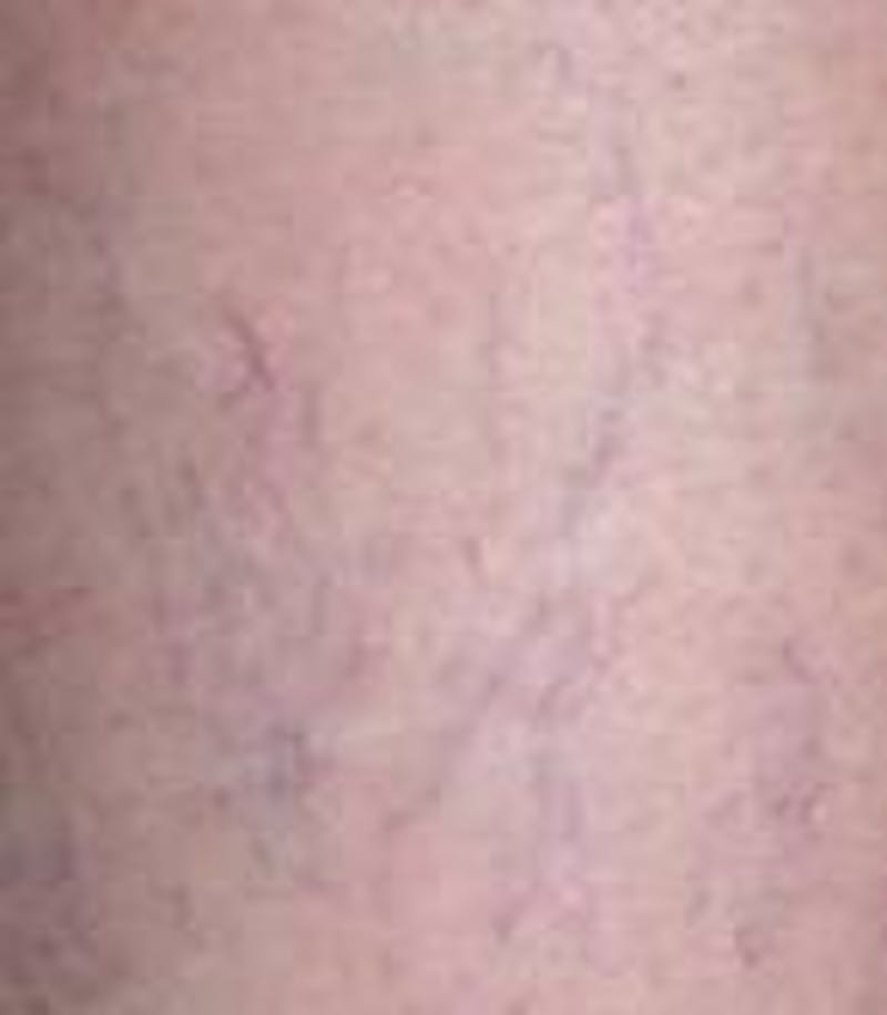 Spider Vein Removal | Varicose Vein Removal Before & After Gallery - Patient 270174 - Image 5 - Scott Chapin, MD