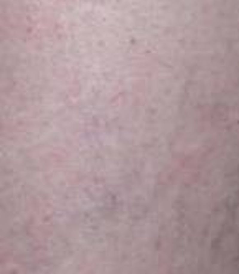 Spider Vein Removal | Varicose Vein Removal Before & After Gallery - Patient 270174 - Image 6 - Scott Chapin, MD