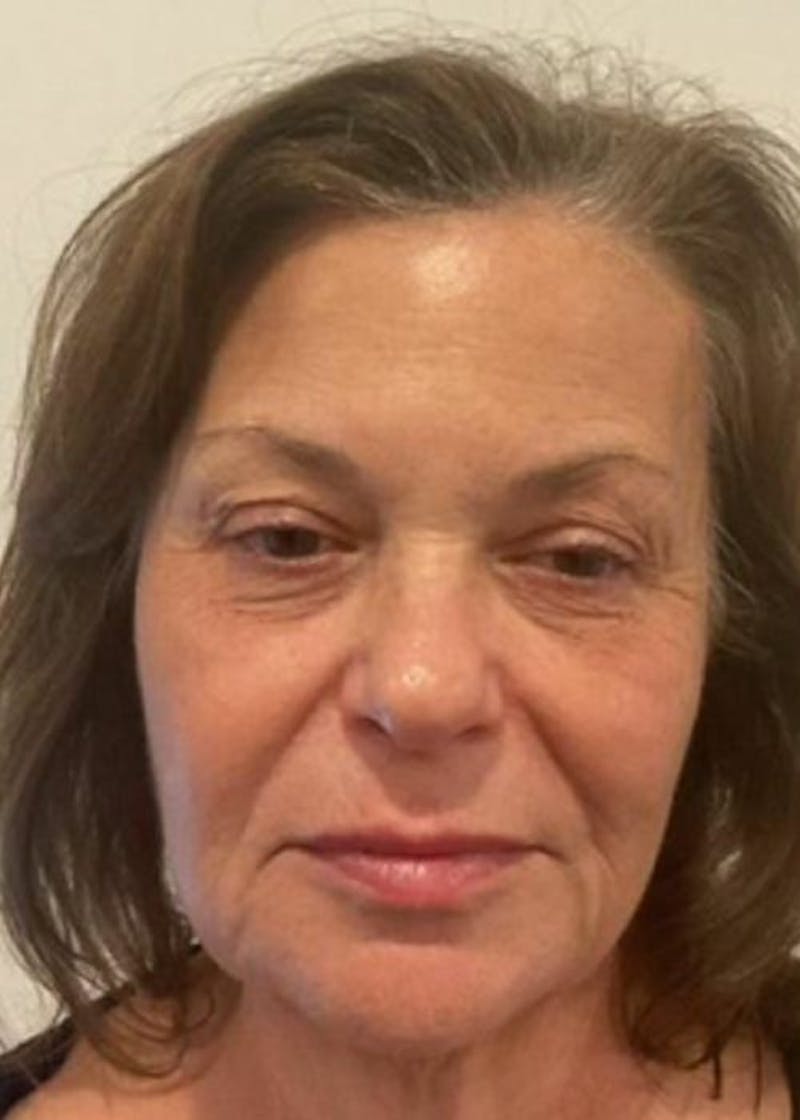 BBL | MOXI Before & After Gallery - Patient 418328 - Image 2 - Scott Chapin, MD