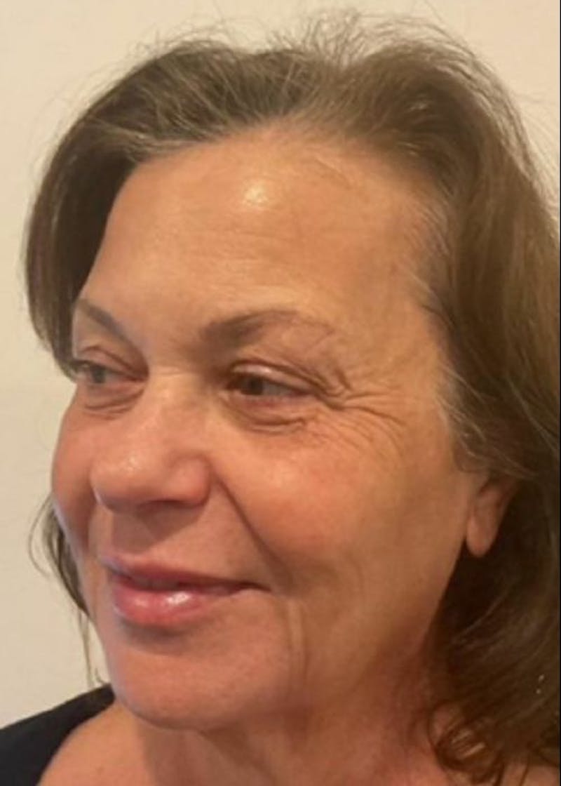 BBL | MOXI Before & After Gallery - Patient 418328 - Image 4 - Scott Chapin, MD