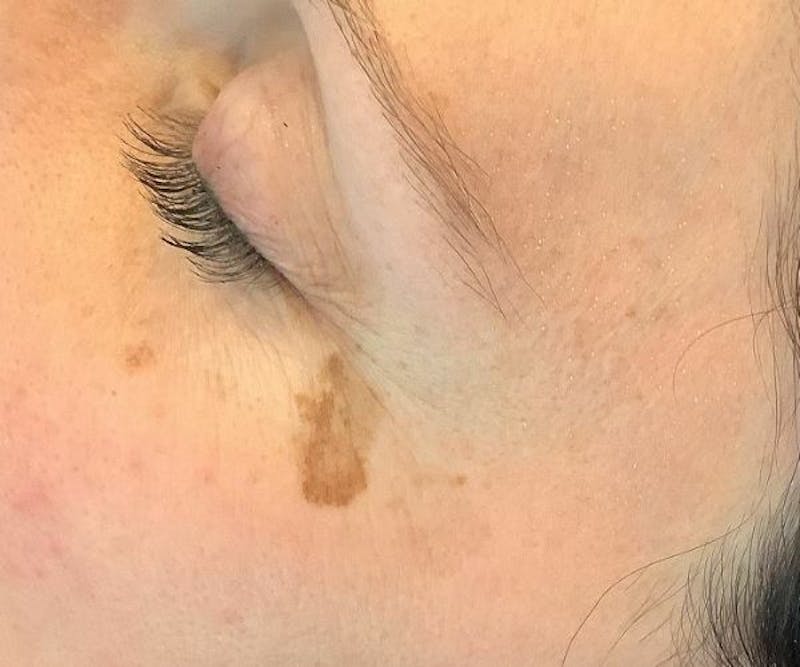 BBL | MOXI Before & After Gallery - Patient 360182 - Image 1 - Scott Chapin, MD