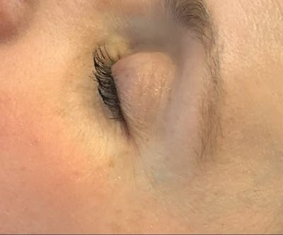 BBL | MOXI Before & After Gallery - Patient 360182 - Image 2 - Scott Chapin, MD