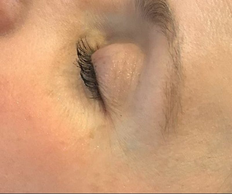 BBL | MOXI Before & After Gallery - Patient 360182 - Image 2 - Scott Chapin, MD