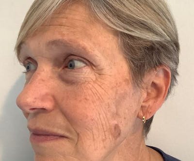 BBL | MOXI Before & After Gallery - Patient 104841 - Image 1 - Scott Chapin, MD