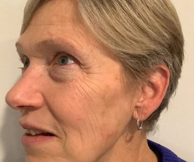 BBL | MOXI Before & After Gallery - Patient 104841 - Image 2 - Scott Chapin, MD