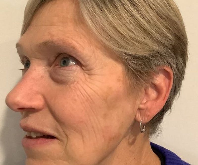 BBL | MOXI Before & After Gallery - Patient 104841 - Image 2 - Scott Chapin, MD