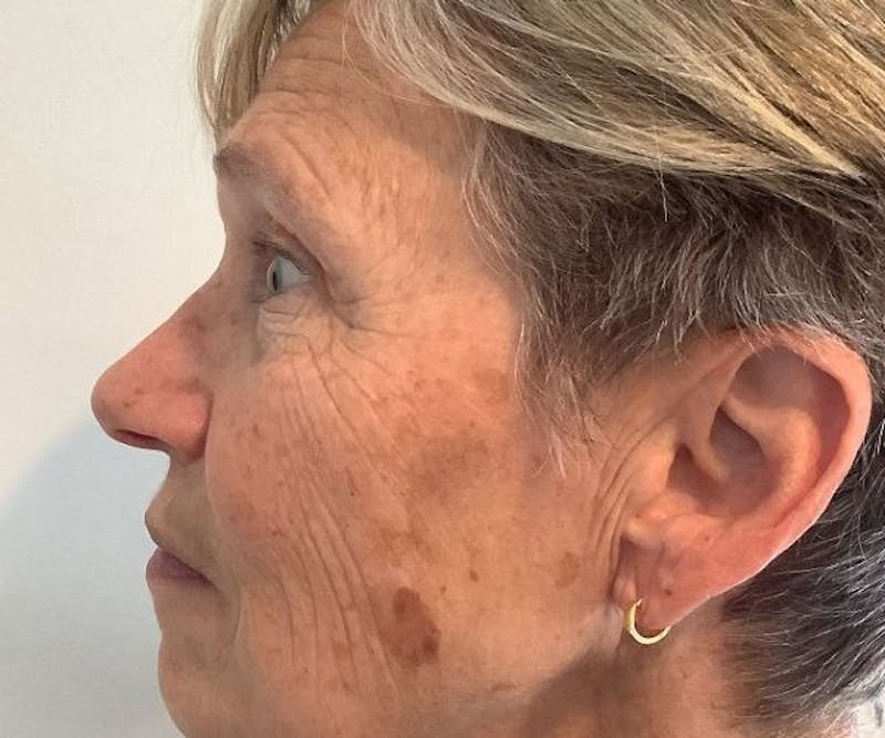 BBL | MOXI Before & After Gallery - Patient 104841 - Image 5 - Scott Chapin, MD