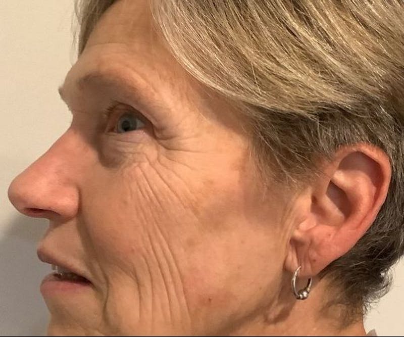 BBL | MOXI Before & After Gallery - Patient 104841 - Image 6 - Scott Chapin, MD