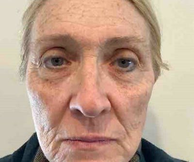 BBL | MOXI Before & After Gallery - Patient 385135 - Image 1 - Scott Chapin, MD