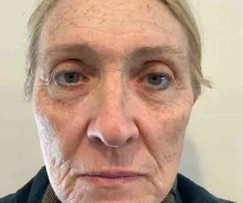 BBL | MOXI Before & After Gallery - Patient 385135 - Image 1 - Scott Chapin, MD