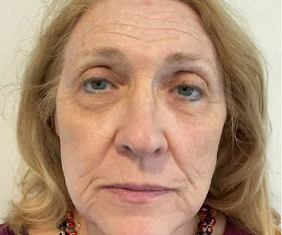 BBL | MOXI Before & After Gallery - Patient 385135 - Image 2 - Scott Chapin, MD