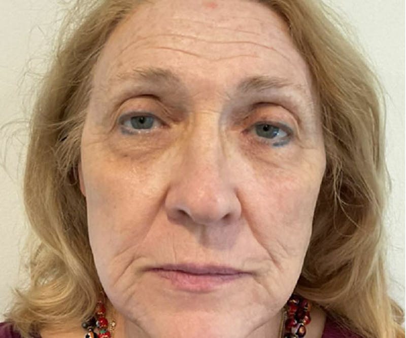 BBL | MOXI Before & After Gallery - Patient 385135 - Image 2 - Scott Chapin, MD