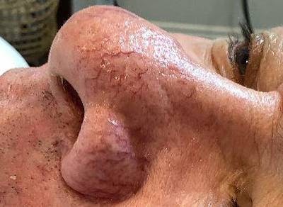 BBL | MOXI Before & After Gallery - Patient 266311 - Image 1 - Scott Chapin, MD
