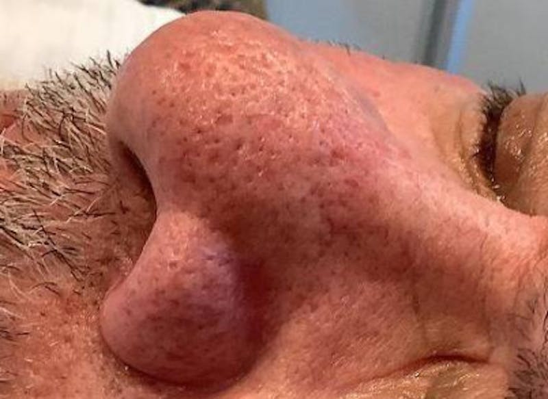 BBL | MOXI Before & After Gallery - Patient 266311 - Image 2 - Scott Chapin, MD