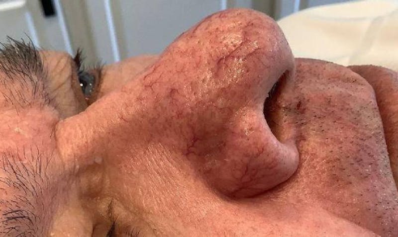 BBL | MOXI Before & After Gallery - Patient 266311 - Image 3 - Scott Chapin, MD