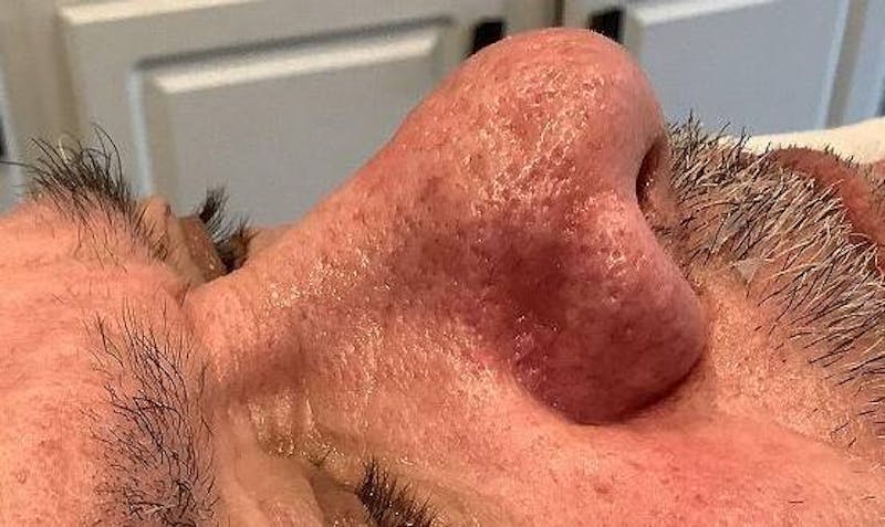 BBL | MOXI Before & After Gallery - Patient 266311 - Image 4 - Scott Chapin, MD