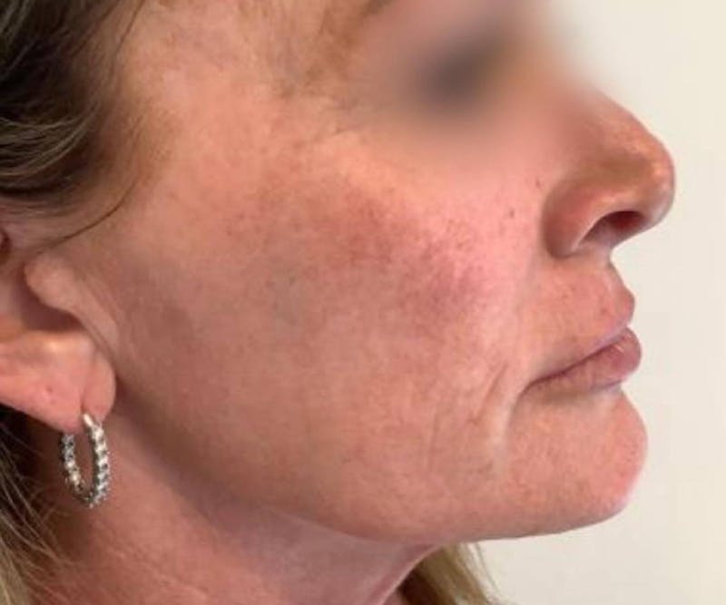 BBL | MOXI Before & After Gallery - Patient 425129 - Image 1 - Scott Chapin, MD