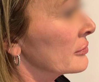 BBL | MOXI Before & After Gallery - Patient 425129 - Image 2 - Scott Chapin, MD